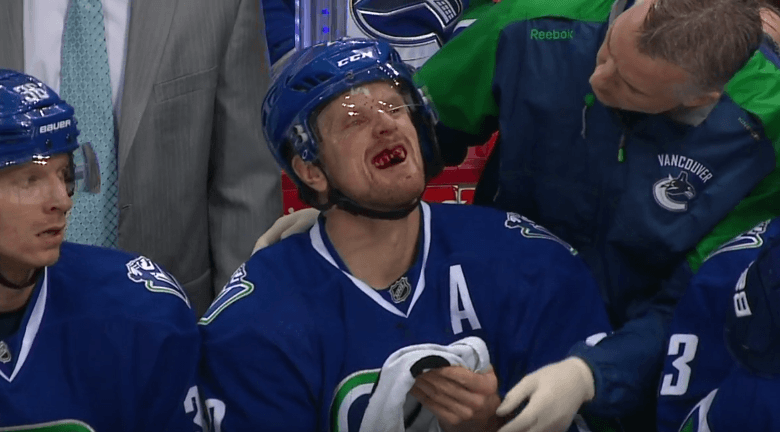 Daniel Sedin Loses Teeth After Taking Puck To The Face (Video)